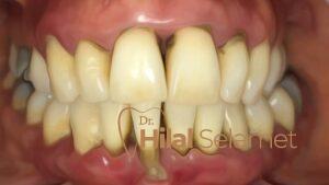 Diş Eti Tedavileri - periodontitis