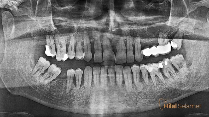 Panoramik Röntgen Diş Filmi, Diş Görüntüleme