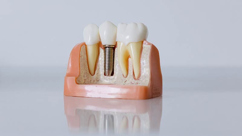 İmplant diş sonrası dikkat edilmesi gereken 5 madde