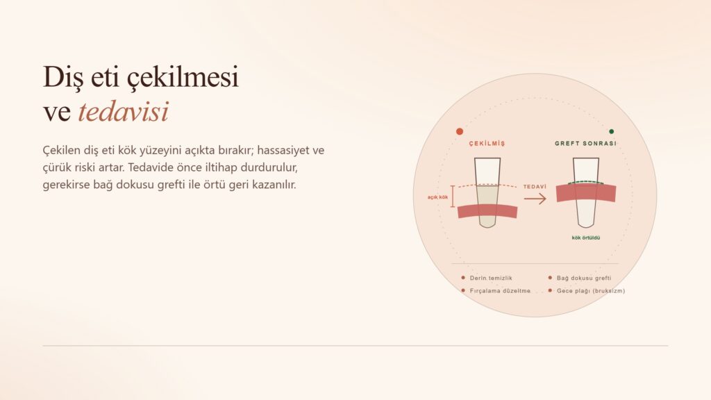 Diş Eti Çekilmesi ve Tedavisi