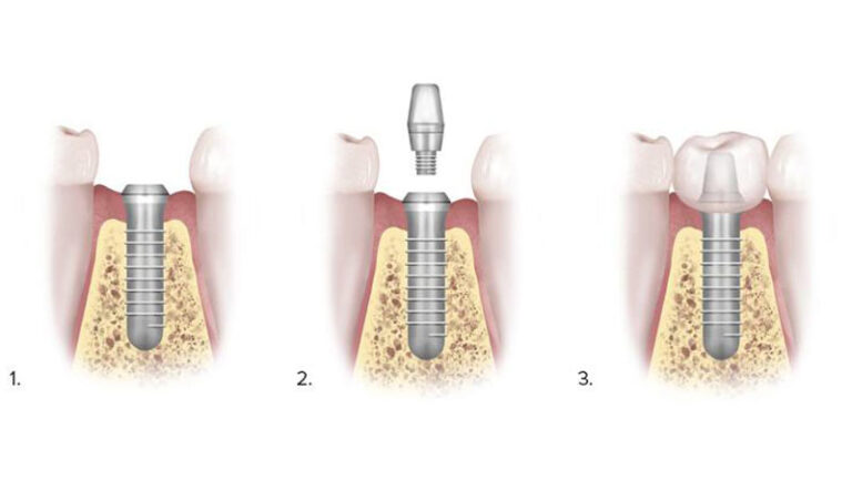 5 Adımda Diş İmplantı Aşamaları Nelerdir? - Dr.Hilal Selamet