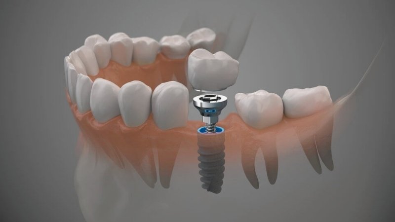 diş implantı neden yapılır