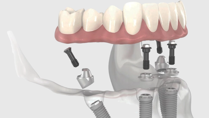 all-on-four implant istanbul