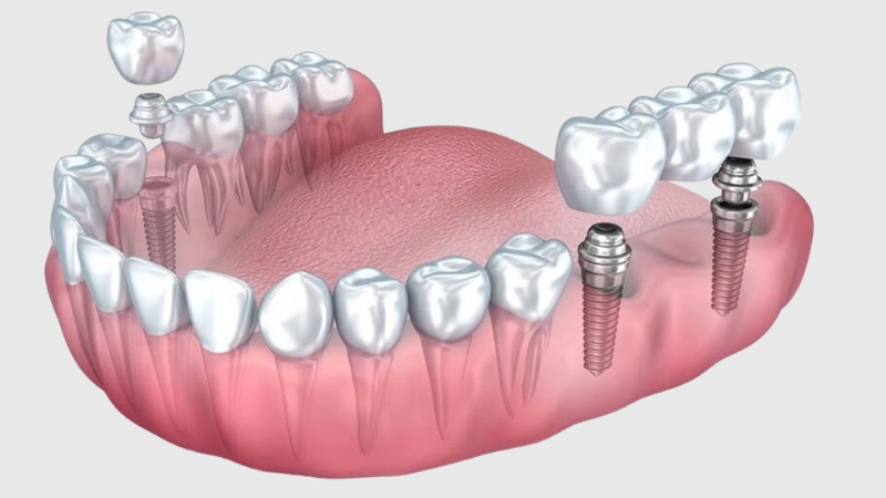 dental implant sökülebilir mi