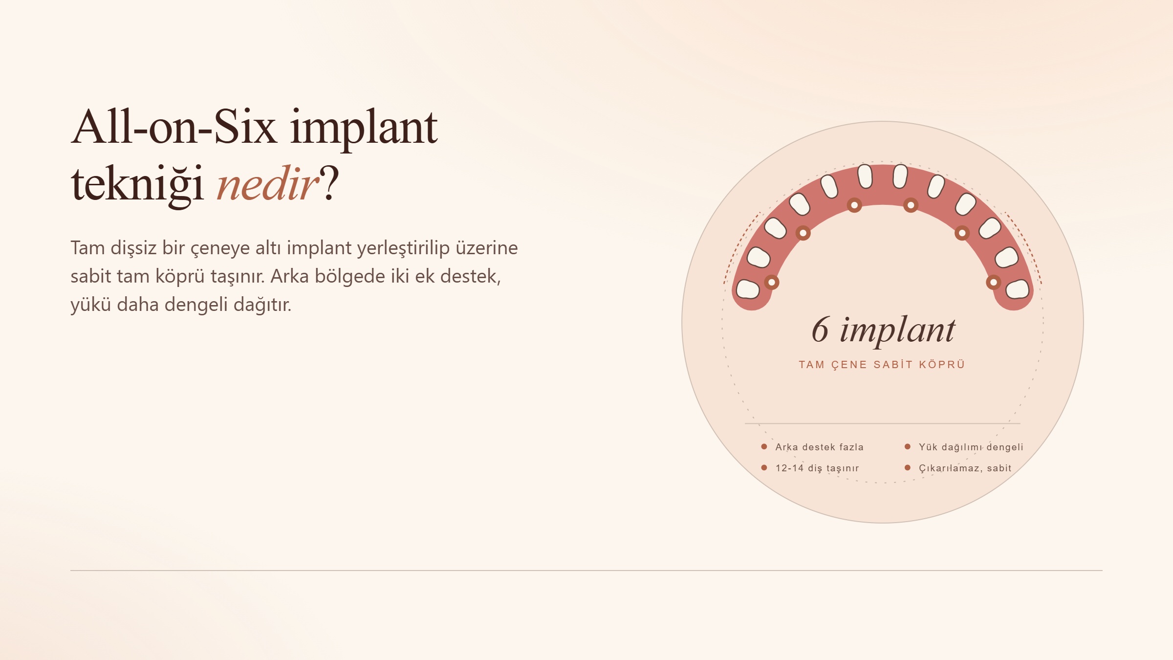 All on six implant tekniği nedir?