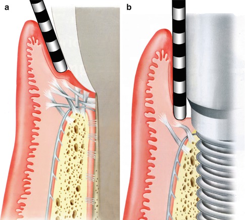 Eksik Dişler için İmplant Öncesi Dişeti Tedavisi Şart mı?