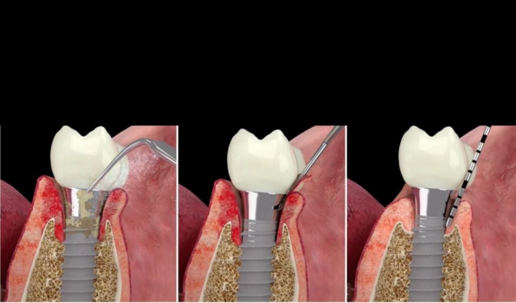 İltihaplı Dişeti Varsa İmplant Yapılabilir mi? Tedavi Süreci Açıklaması