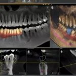 3 Boyutlu Diş Tomografisi (CBCT) Nedir?