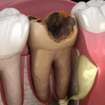 Enfekte Kök Dişler Çekilip Hemen İmplant Yapılabilir mi?