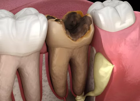 Enfekte Kök Dişler Çekilip Hemen İmplant Yapılabilir mi?