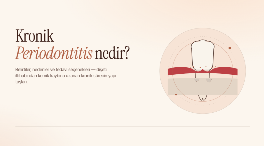 Kronik Periodontitis Nedir? Belirtileri, Nedenleri ve Tedavisi