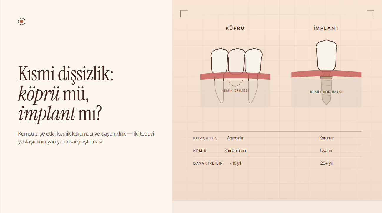 Kısmi Dişsizlik Neden İmplantla Çözülmeli? Köprü mü, İmplant mı?