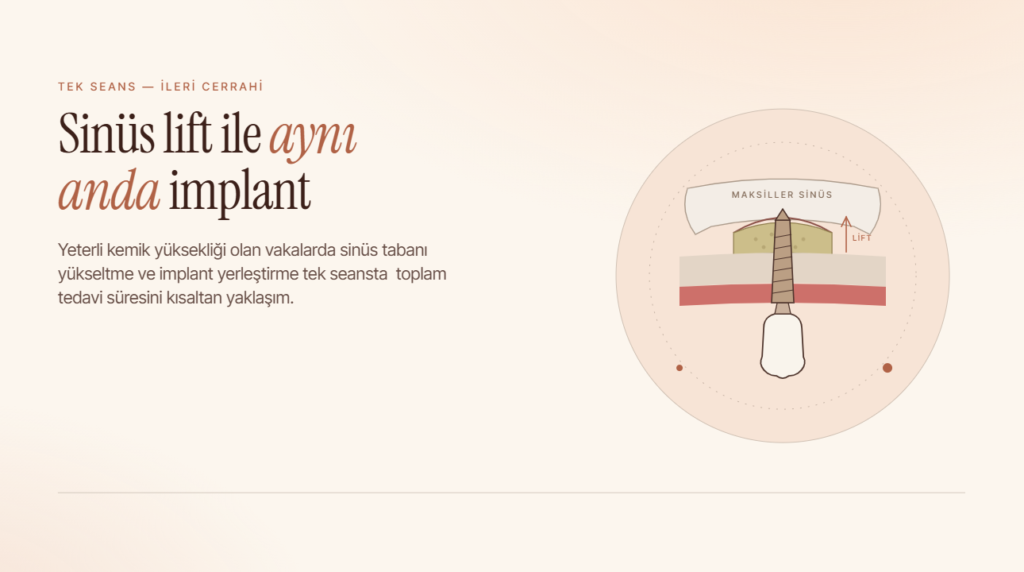 Sinüs Lift ile Aynı Anda İmplant Mümkün mü?