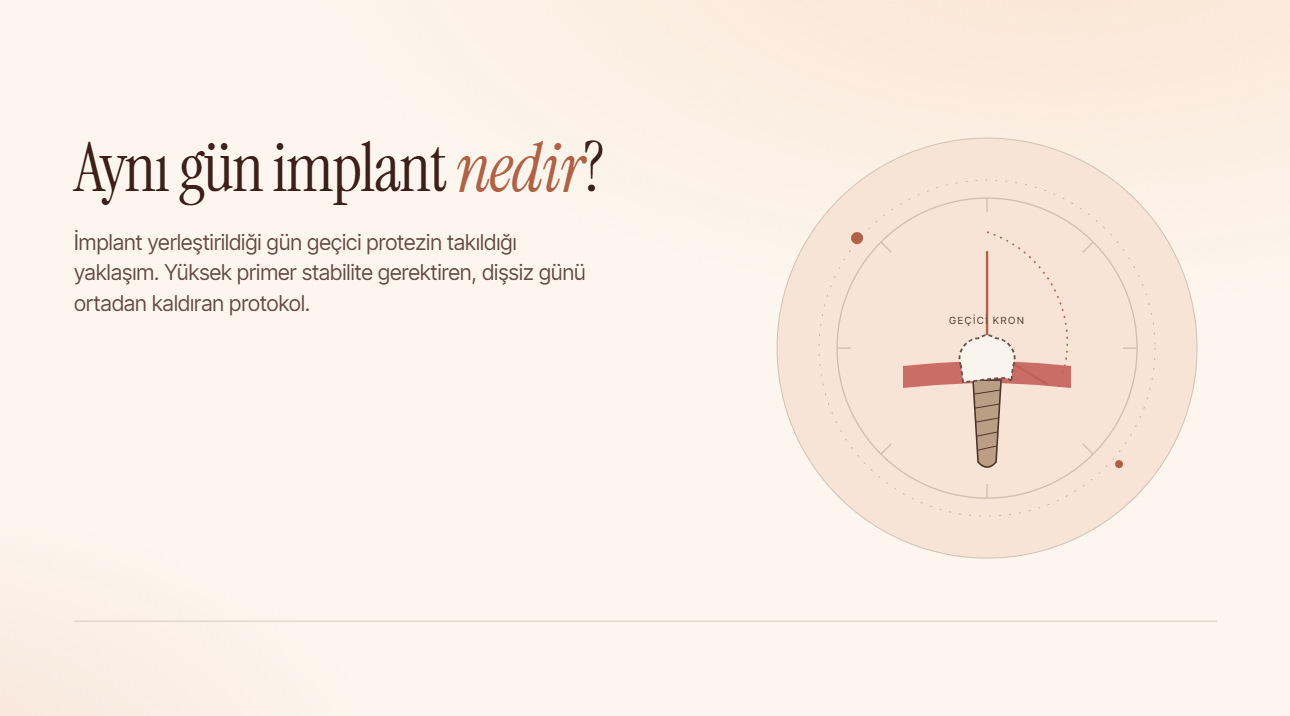 Aynı Gün İmplant (Immediate Loading) Nedir?