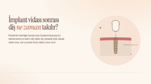 İmplant Vidası Takıldıktan Sonra Diş Ne Zaman Takılır?