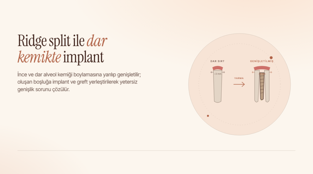 Ridge Split (Kemik Genişletme) ile İmplant