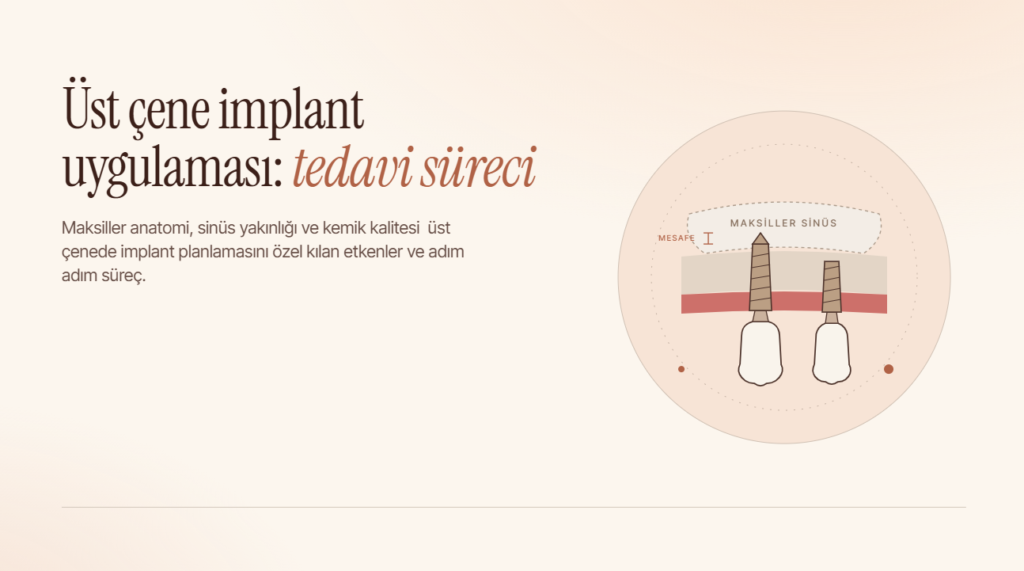 Üst Çene İmplant Uygulaması: Tedavi Süreci