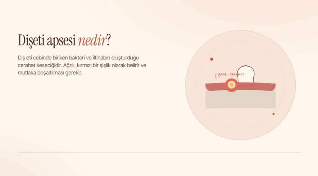 Dişeti Apsesi Nedir? Belirtileri ve Tedavi Yöntemleri