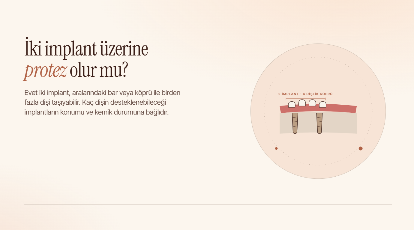 İki İmplant Üzerine Protez Olur mu?