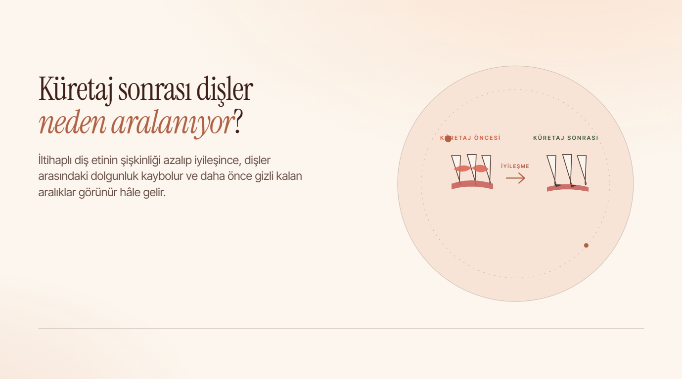 Küretaj Sonrası Dişler Neden Aralanıyor?