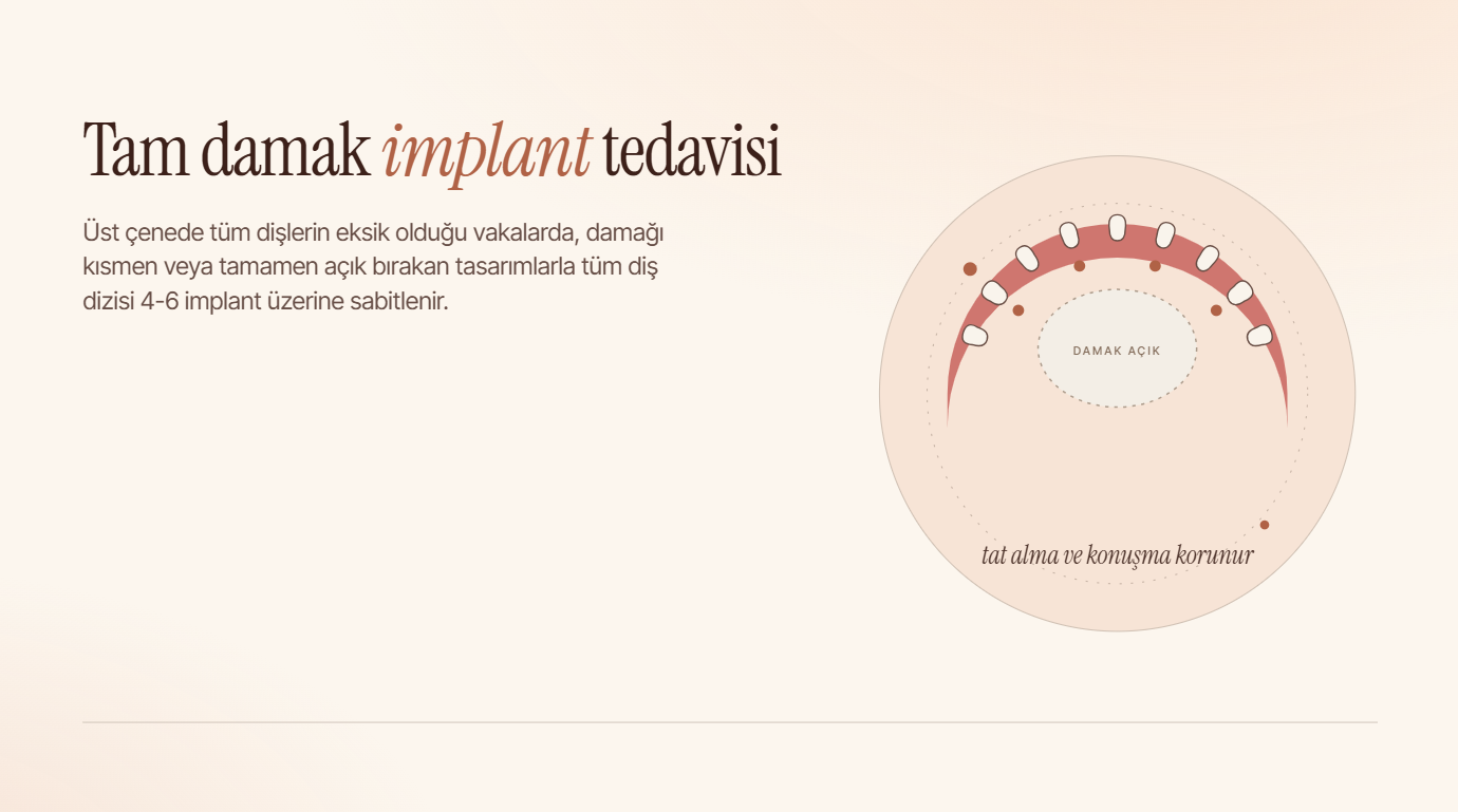 Tam Damak İmplant Tedavisi