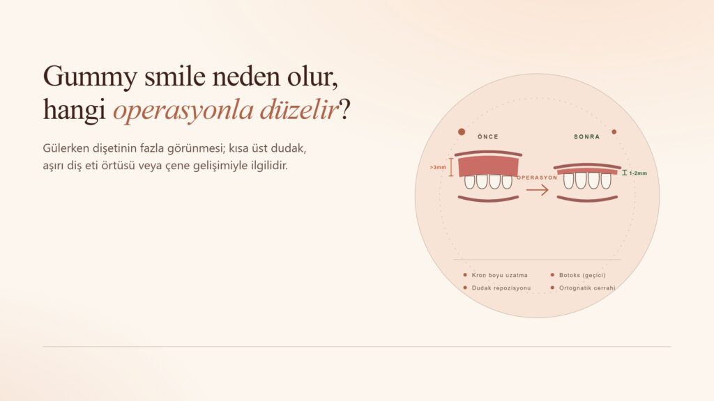Gummy Smile Neden Olur ve Hangi Operasyonla Düzelir?