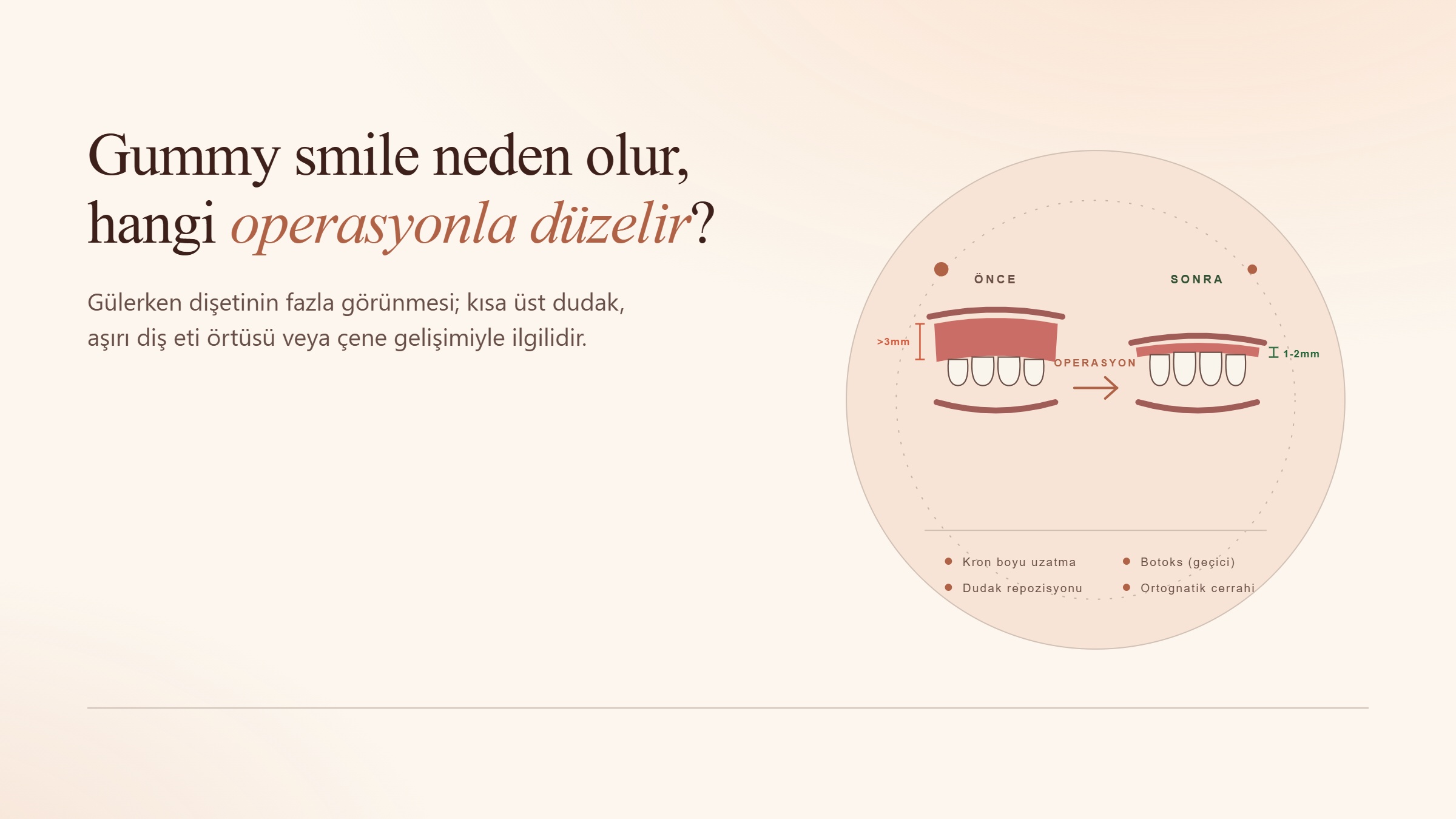 Gummy Smile Neden Olur ve Hangi Operasyonla Düzelir?