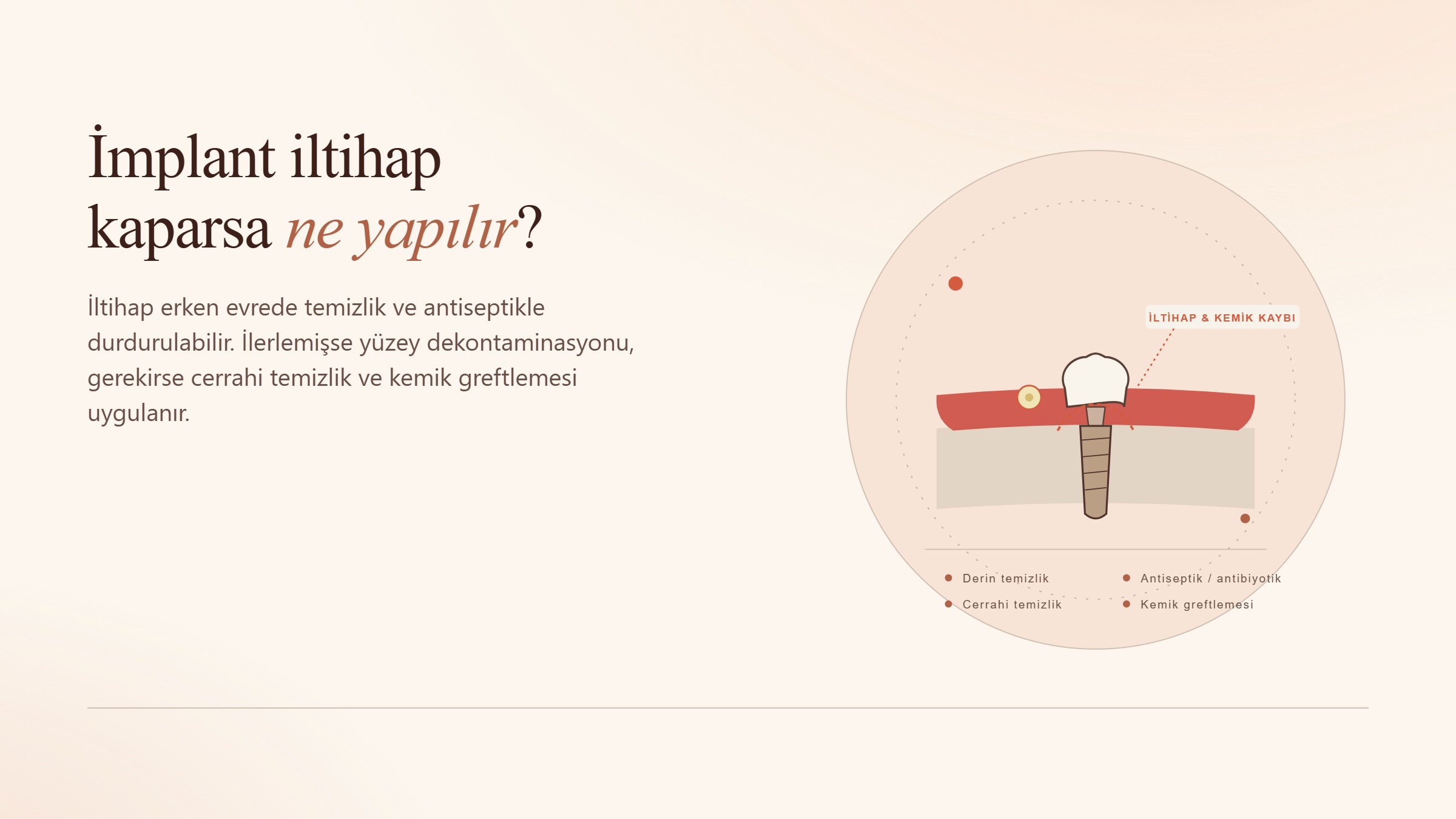 İmplant İltihap Kaparsa Ne Yapılır?