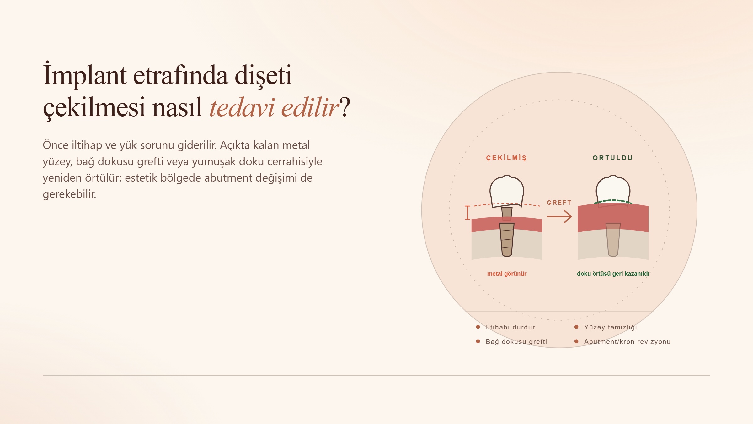 İmplant Etrafında Dişeti Çekilmesi Nasıl Tedavi Edilir?