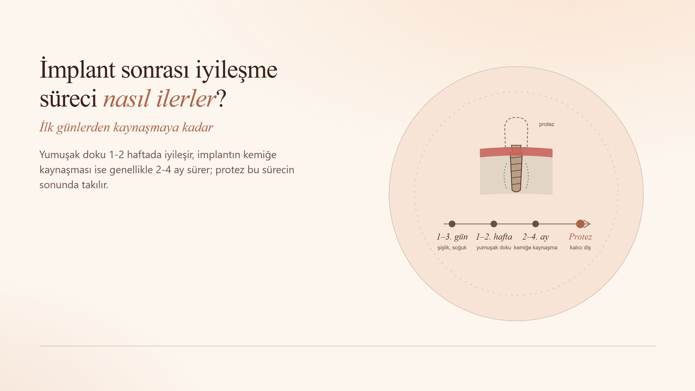 İmplant Sonrası İyileşme Süreci Nasıl İlerler? İlk Günlerden Kaynaşmaya