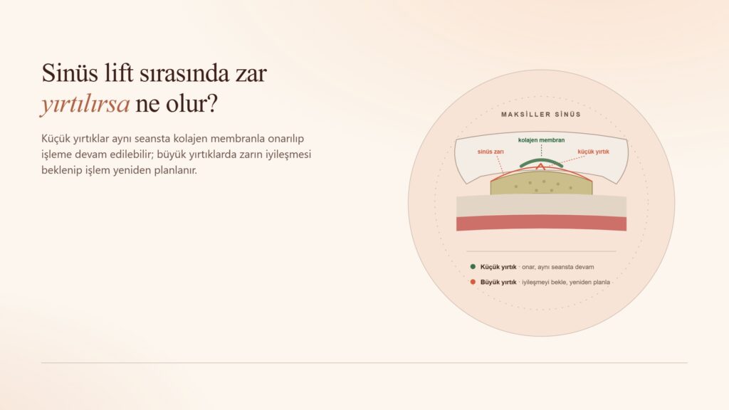 Sinüs Lift Sırasında Zar Yırtılırsa Ne Olur?